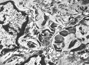 M, 17y. | Fabry disease - skin M, 17y. | Fabry disease - skin